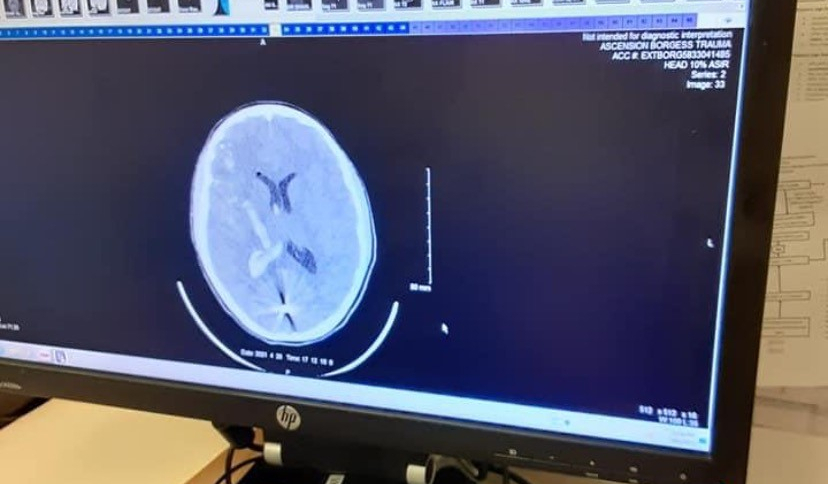Boy on life support with BB lodged in brain: ‘We’re